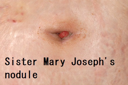 Sister Mary Joseph's nodule Sister Mary Joseph's nodule